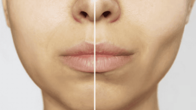 buccal-fat-removal-barbies-beauty-bits